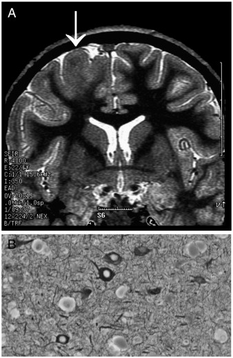 Balloon Cell Cortical Dysplasia