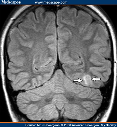 Balloon Cell Cortical Dysplasia