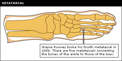 Bruised Metatarsal Bone