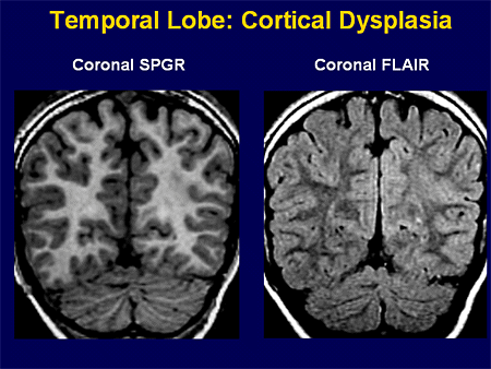 Cortical Dysplasia Histopathology