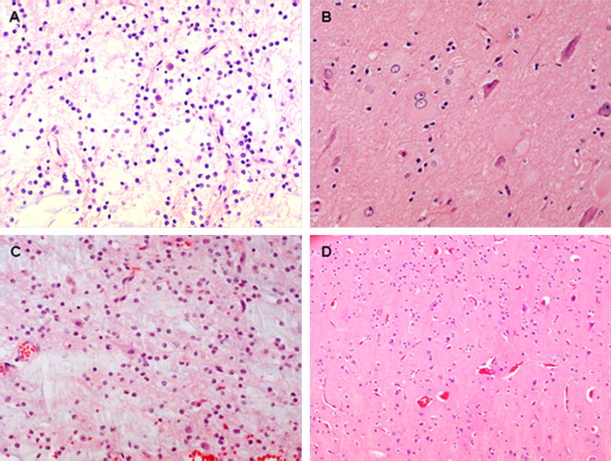 Cortical Dysplasia Histopathology