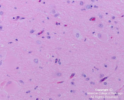 Cortical Dysplasia Histopathology