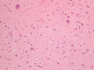 Cortical Dysplasia Histopathology