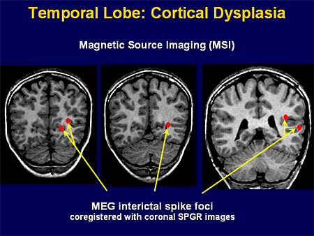 Cortical Dysplasia Histopathology