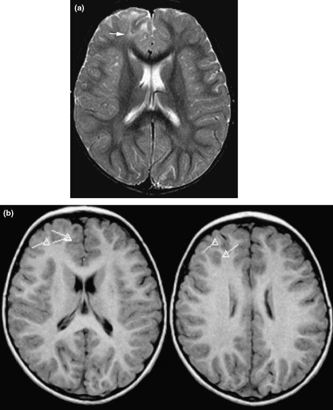 Cortical Dysplasia Mri