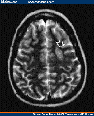 Cortical Dysplasia Mri