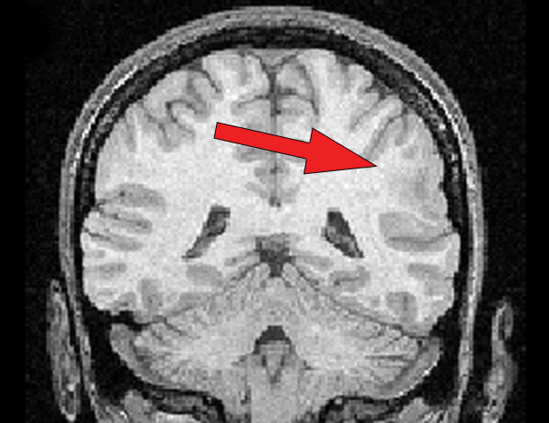 Cortical Dysplasia Mri