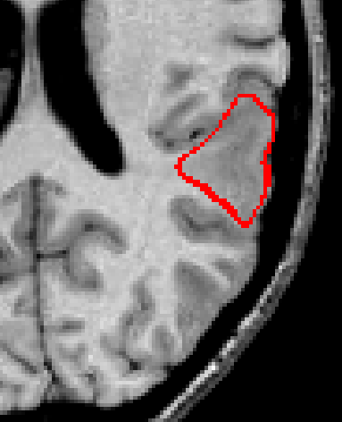 Cortical Dysplasia Mri