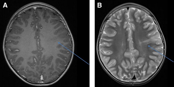 Cortical Dysplasia Radiographics