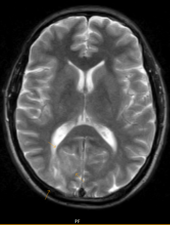 Cortical Dysplasia Radiographics