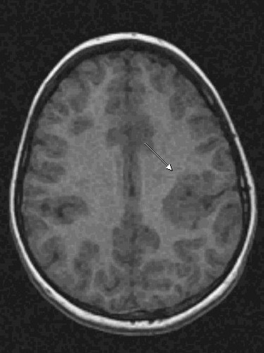 Cortical Dysplasia Radiographics