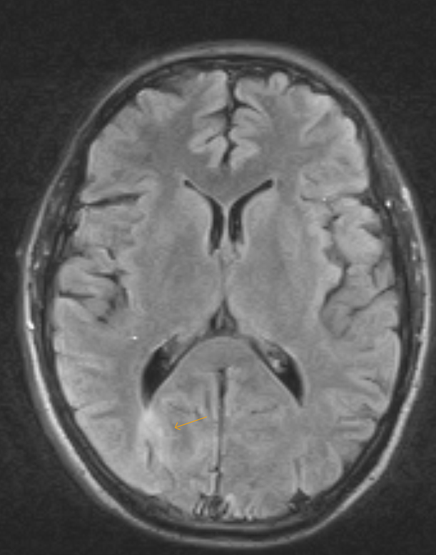 Cortical Dysplasia Radiographics