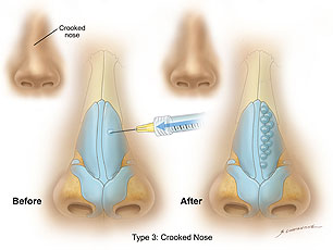 Crooked Nose Surgery