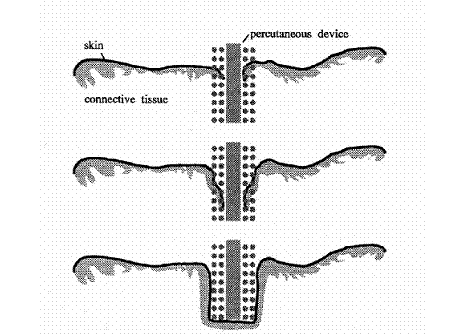 Dacron Cuff Purpose