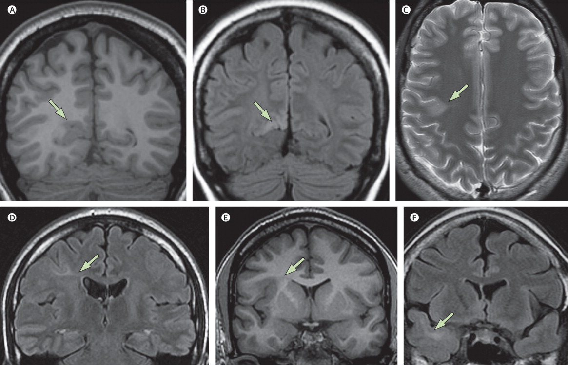 Focal Cortical Dysplasia