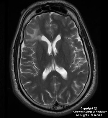 Focal Cortical Dysplasia