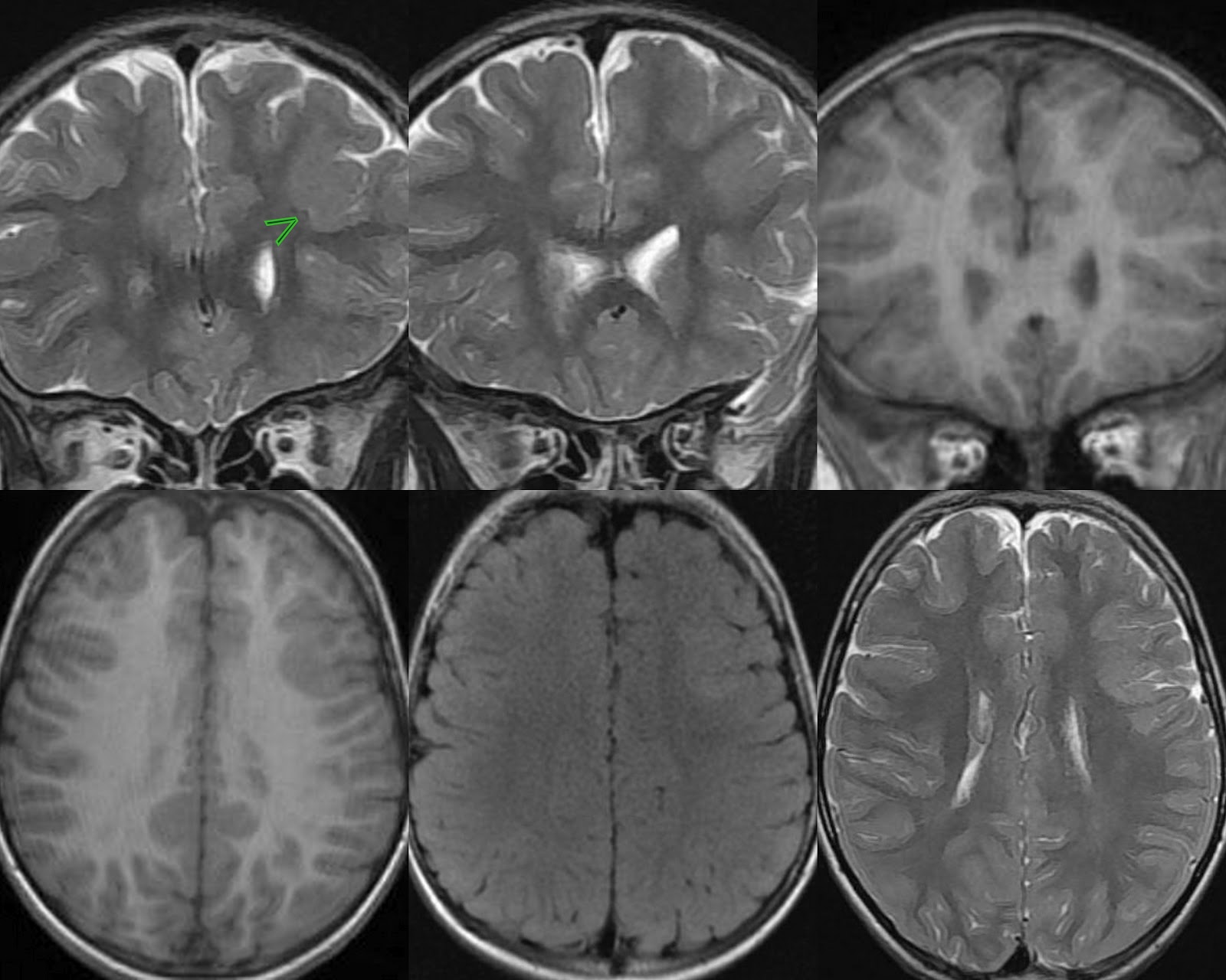 Focal Cortical Dysplasia Mri