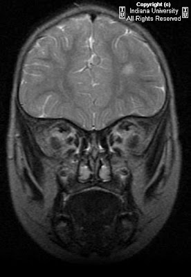 Focal Cortical Dysplasia Mri