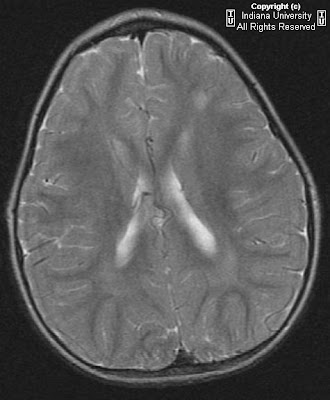 Focal Cortical Dysplasia Mri