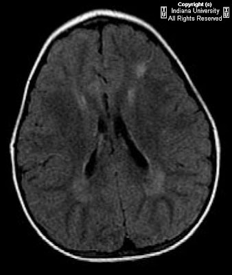 Focal Cortical Dysplasia Mri