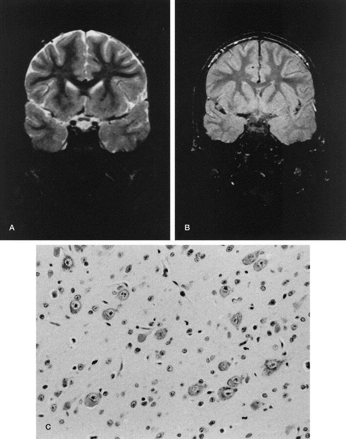 Focal Cortical Dysplasia Radiographics