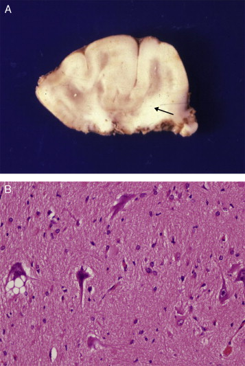 Focal Cortical Dysplasia Radiology