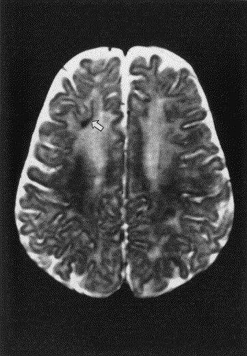 Focal Cortical Dysplasia Radiology